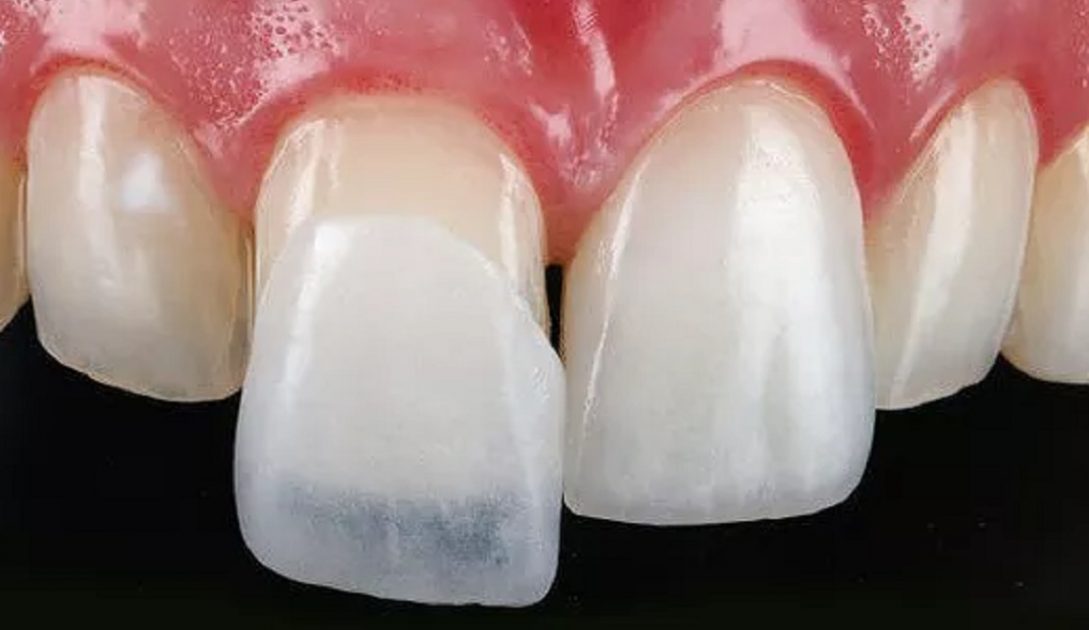 مقایسه بین لمینت دندان و ایمپلنت دندان