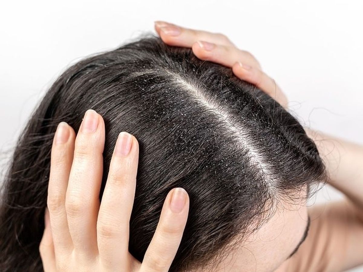آیا دستکاری کردن مو هم سبب ایجاد شوره سر می‌شود؟